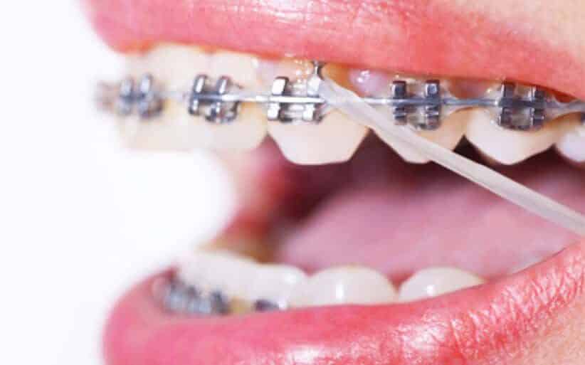Gomas para brackets en ortodoncia, ¿qué son?